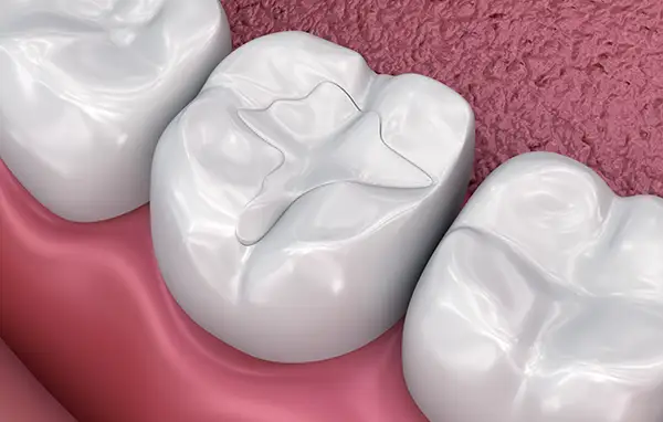 A 3d rendering of dental fillings on back teeth