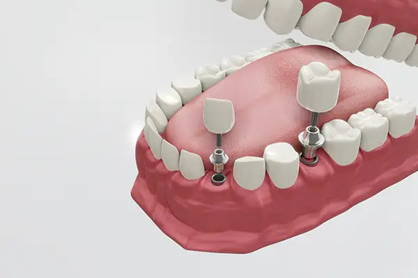 A 3d rendering of dental implants being placed in a mouth