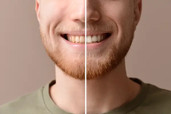 A before and after of whitening on a man's smile